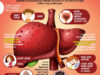 hepatitis